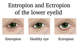 ECTROPION